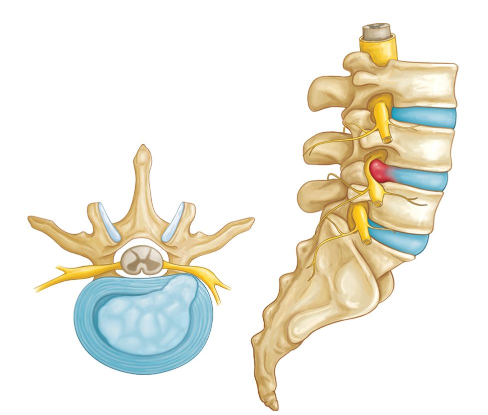 Herniated discs