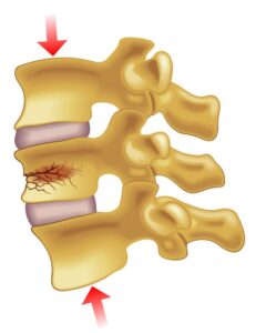Spinal Fracture