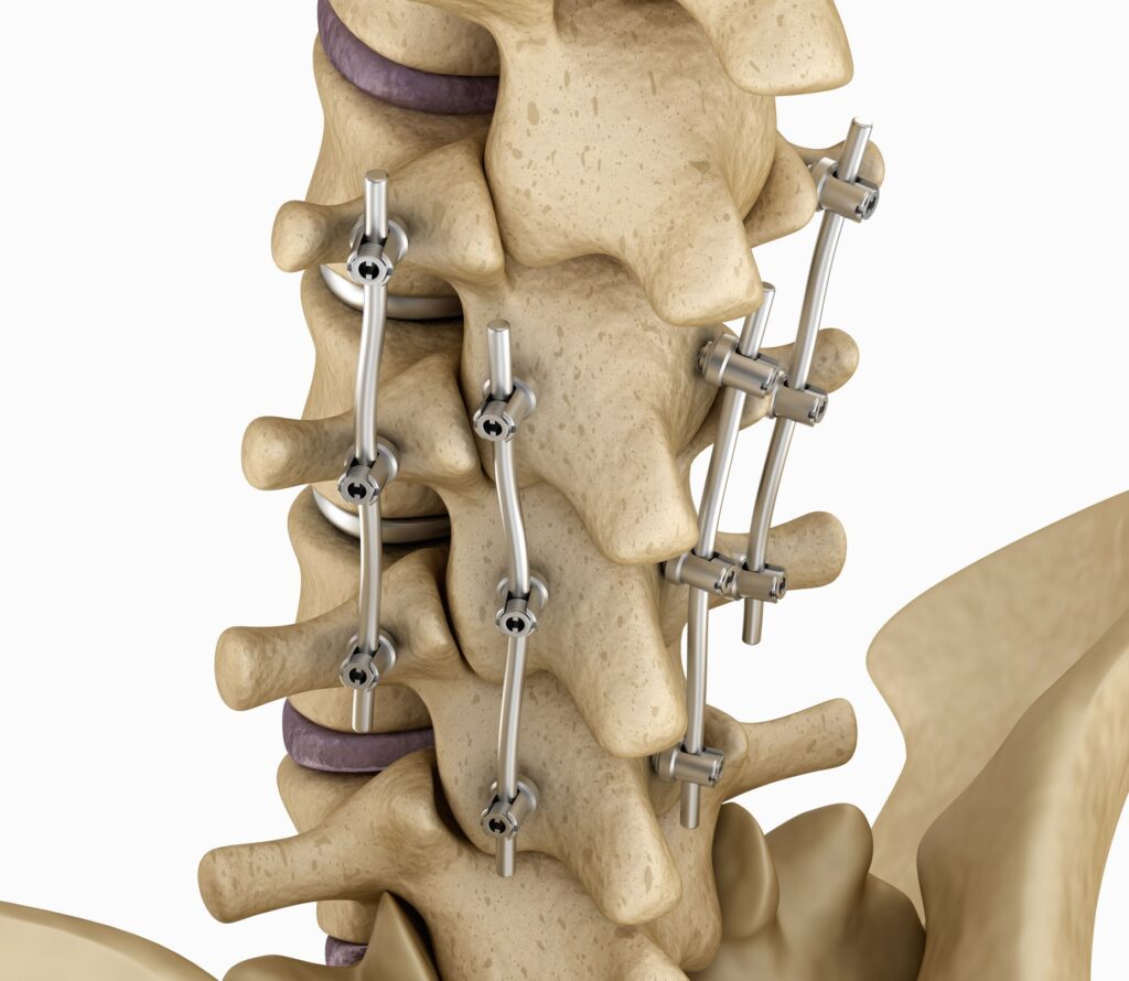 Spinal Fusion