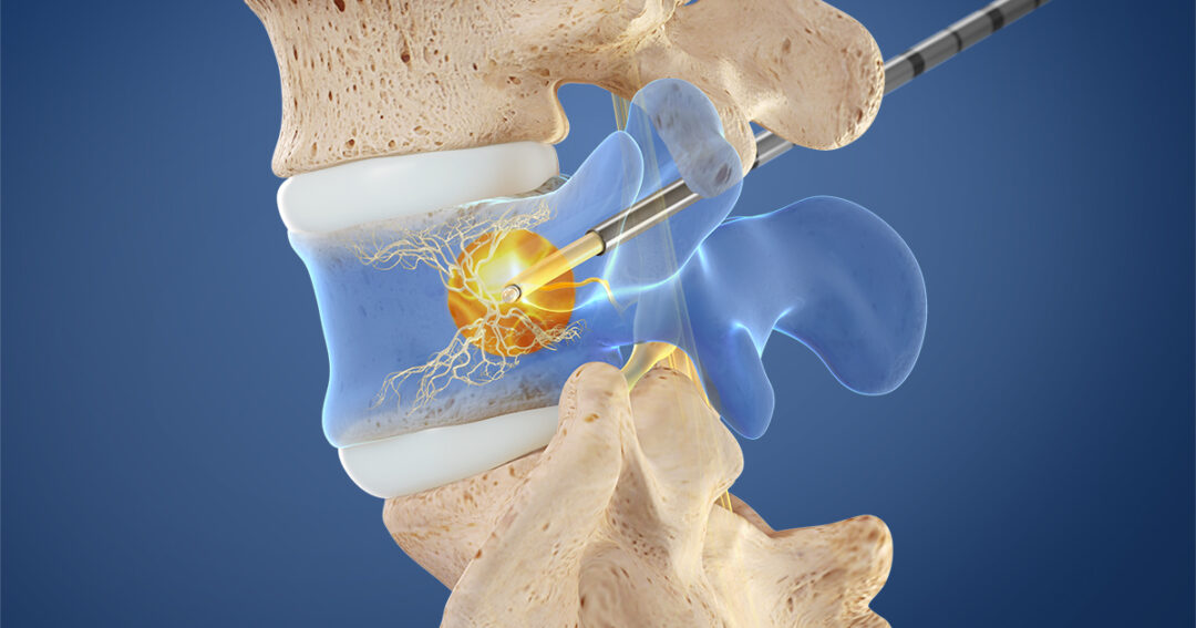 INTRACEPT PROCEDURE - Longhorn Brain and Spine