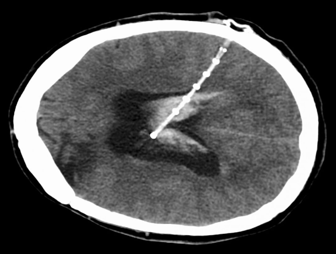 ventriculoperitoneal-shunts-longhorn-brain-and-spine