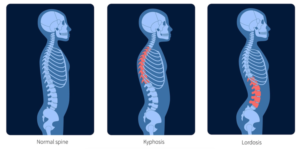 LORDOSIS - Longhorn Brain and Spine